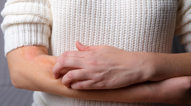What are Hives? | Symptoms of Hives | LloydsPharmacy What are Hives? | Symptoms of Hives | LloydsPharmacy