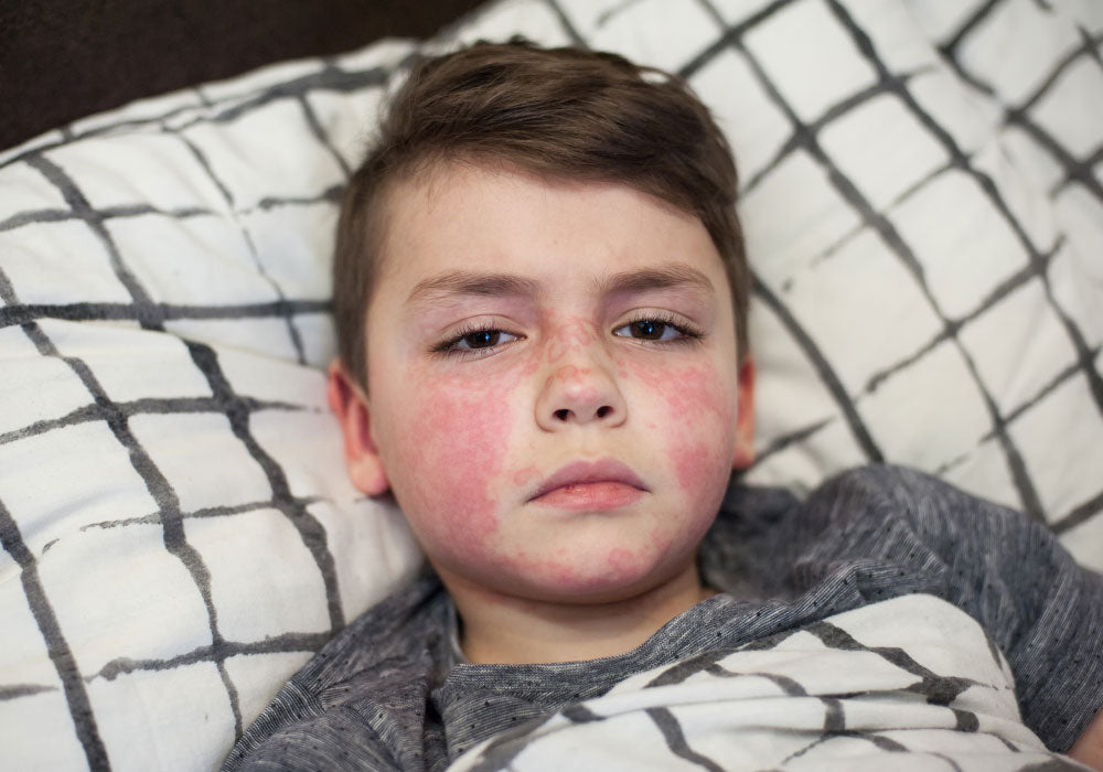 Strep A: Two more penicillin medicines added to list of alternatives - as scarlet  fever cases 'three times higher than normal', UK News