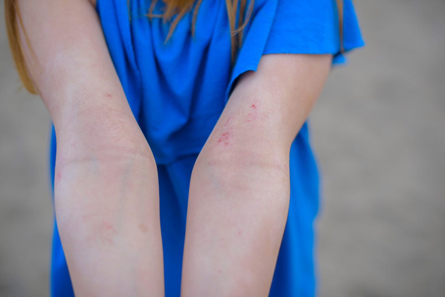 Varicose eczema - NHS