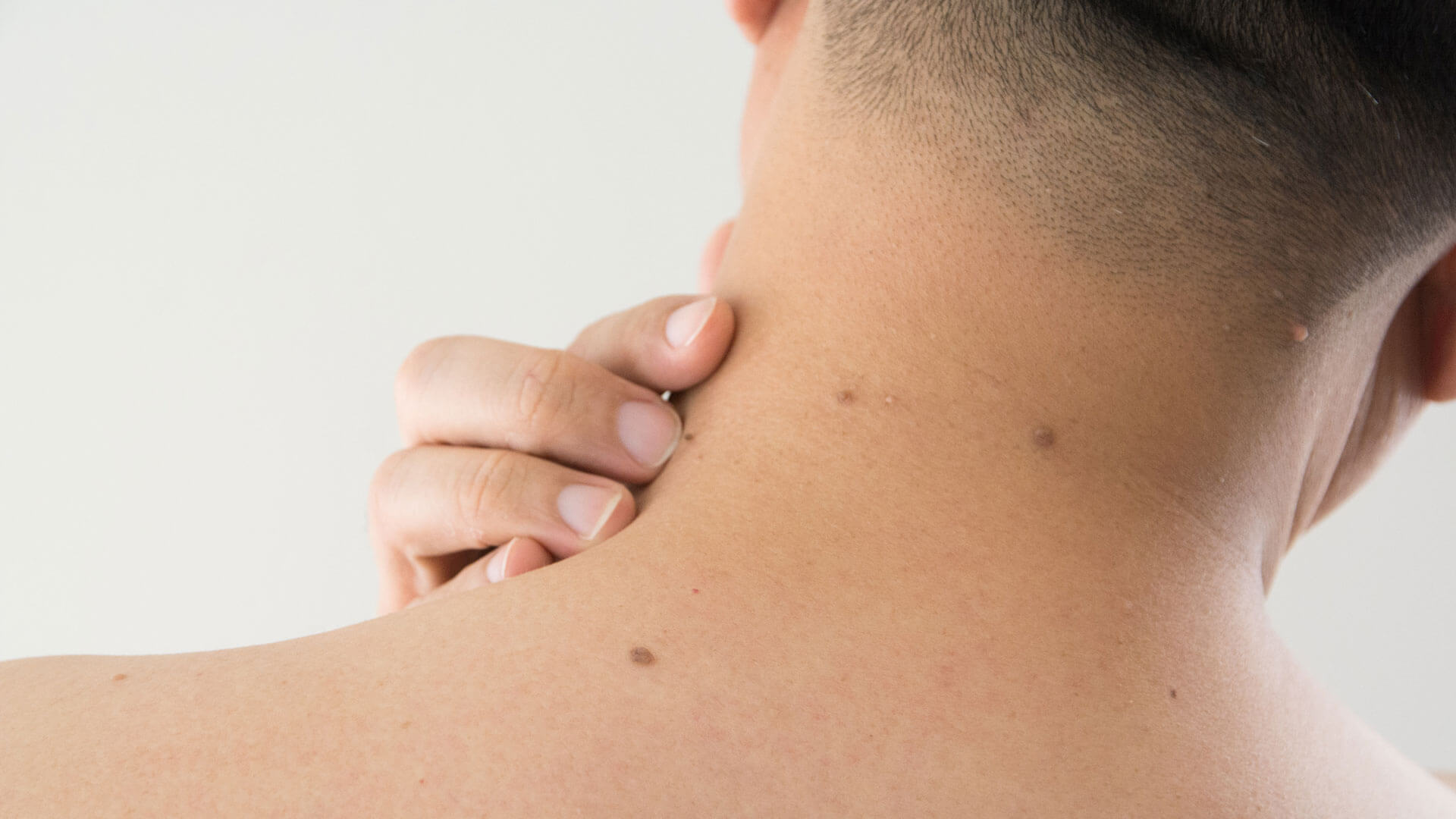 how to get rid of warts on neck