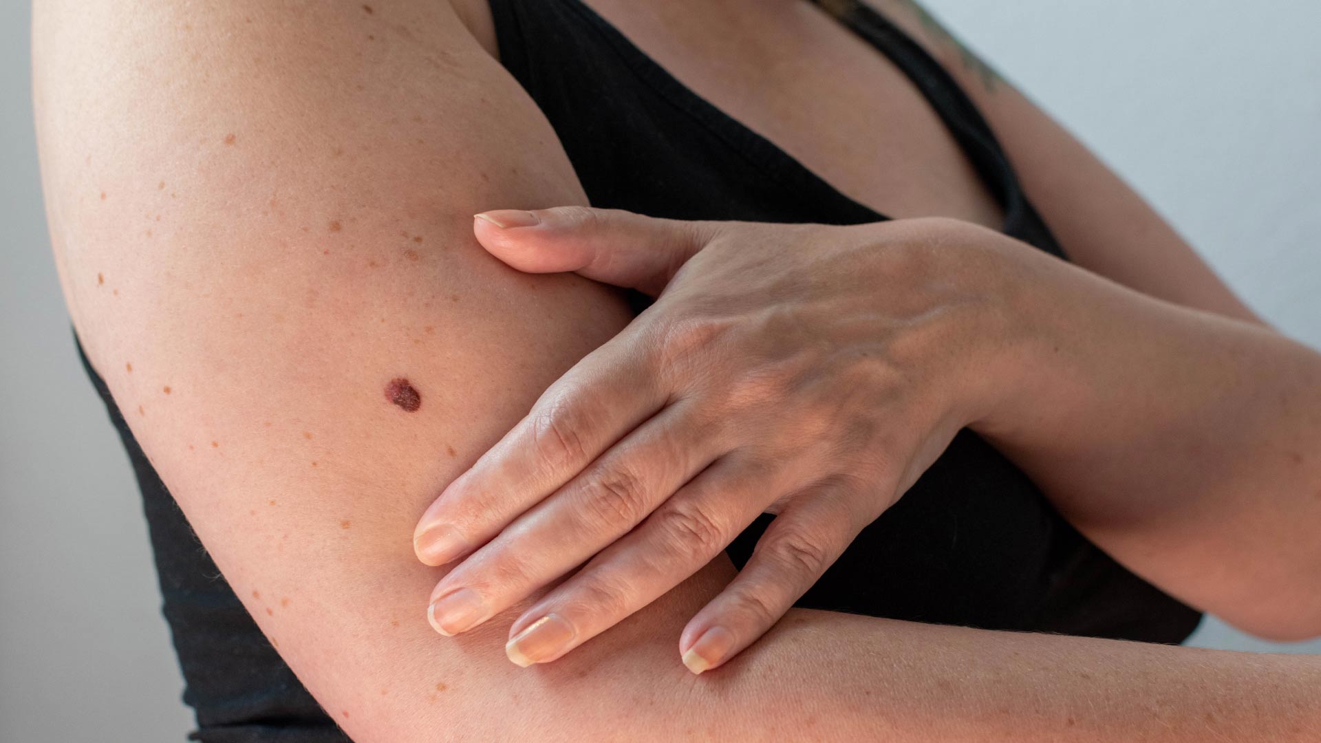 Types Of Moles On The Body types-of-moles-on-the-body