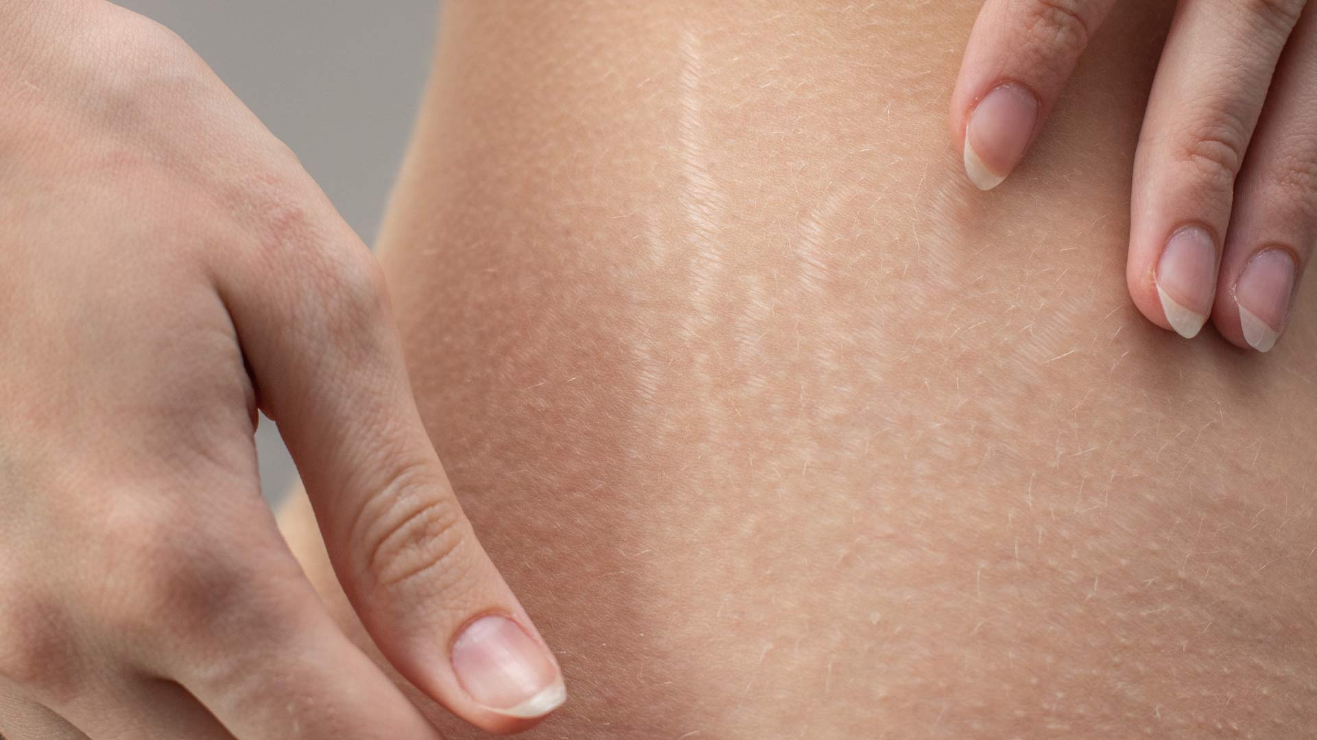 Stretch Mark Neck: Causes, Treatment, and Prevention