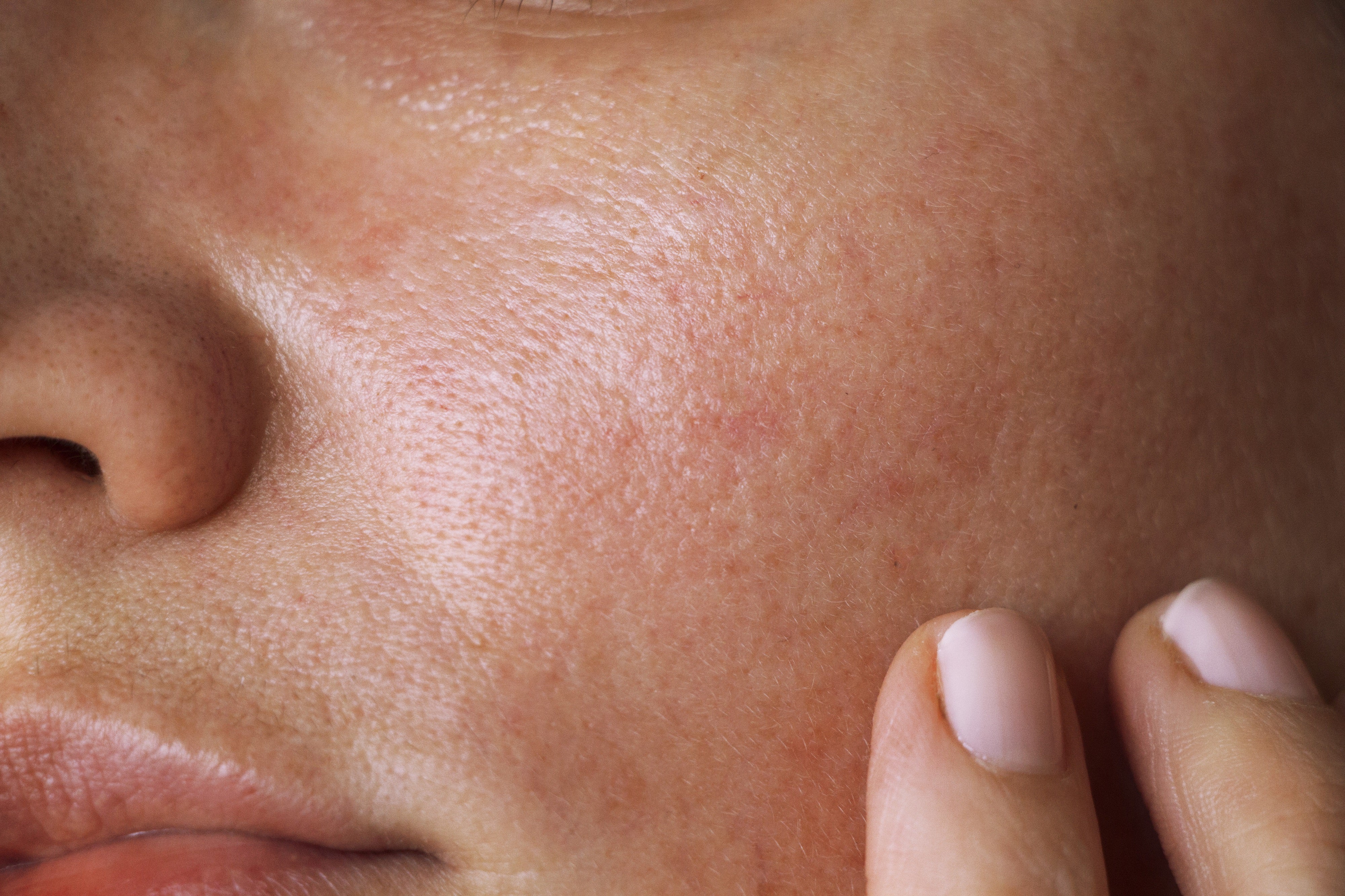 atopic dermatitis on face