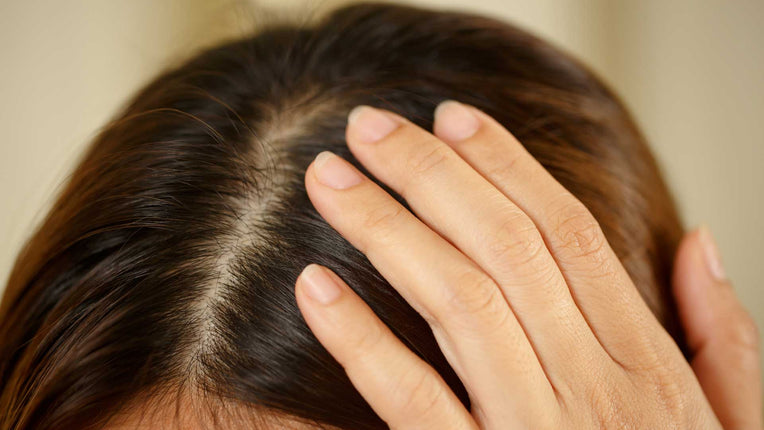 7 Top Hair Oils For Dandruff: Control Itching And Flaking