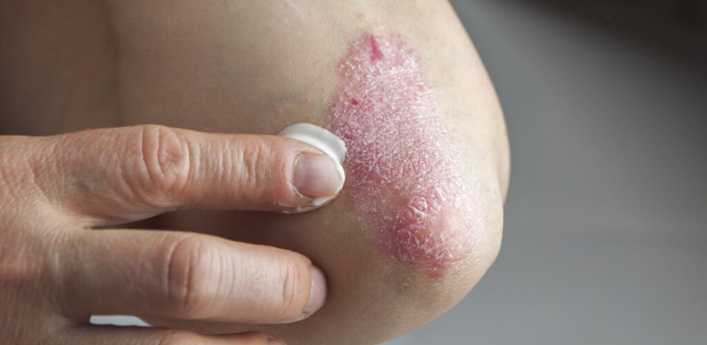 Understanding Psoriasis: Psoriasis Types & Treatments | LloydsPharmacy