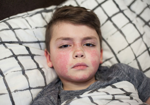 Scarlet Fever: Signs, Symptoms, and Treatment