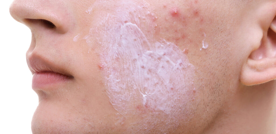 Acne spots: what are they?