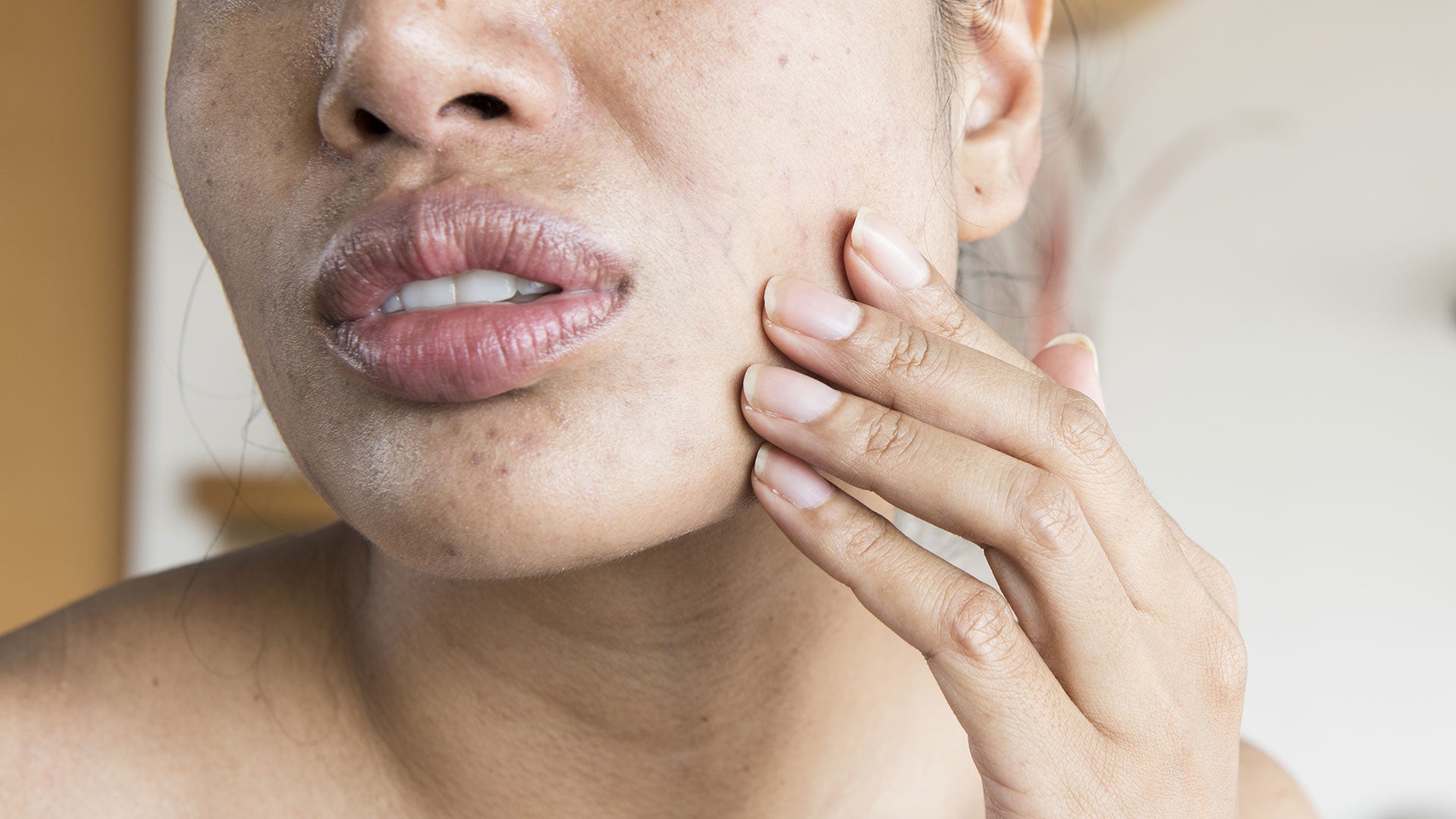 Skin Condicion Skin conditions in different skin tones | LloydsPharmacy